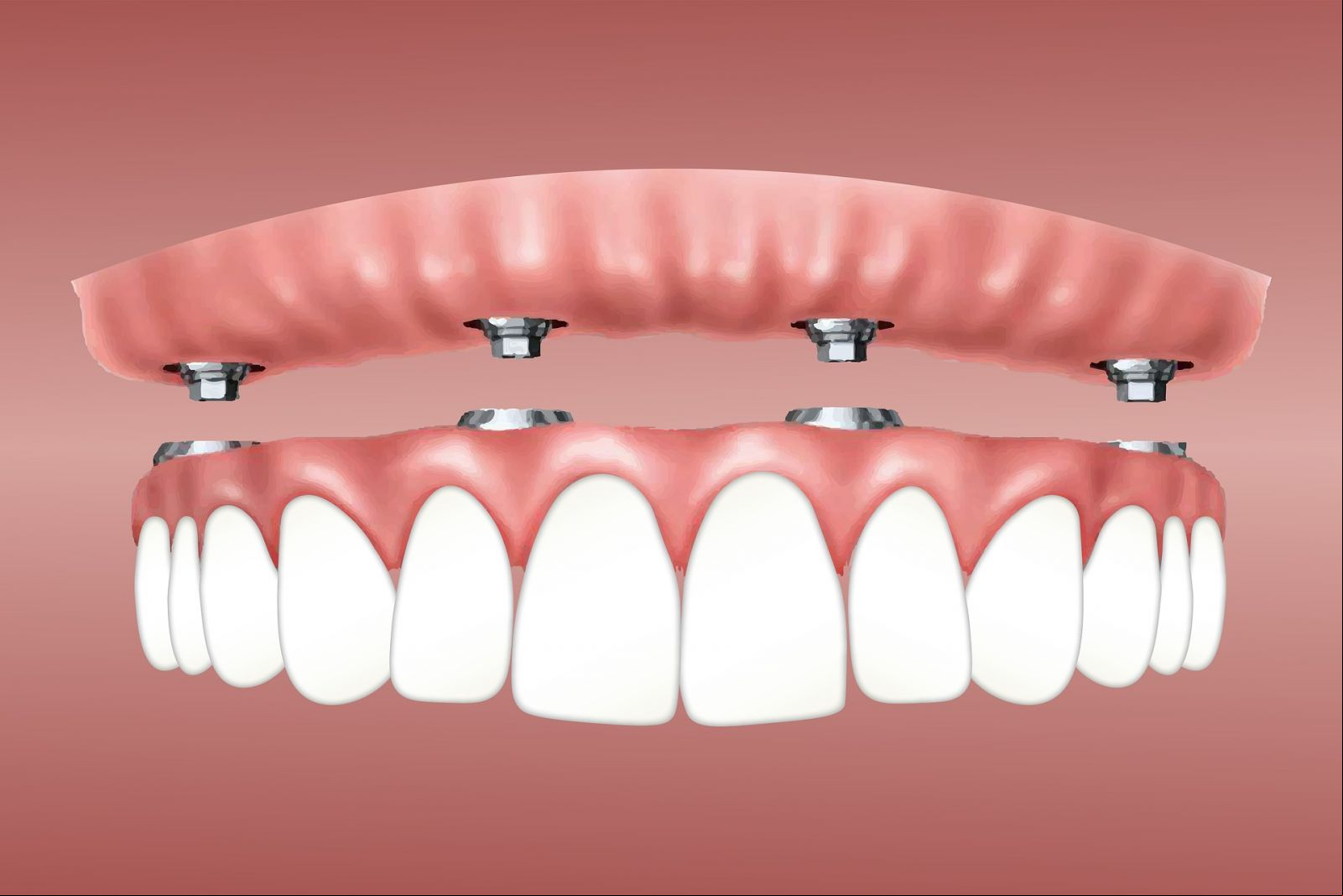 Segnini explica que a colocação de um implante dentário oferece um e estável para a prótese, que é um dente artificial